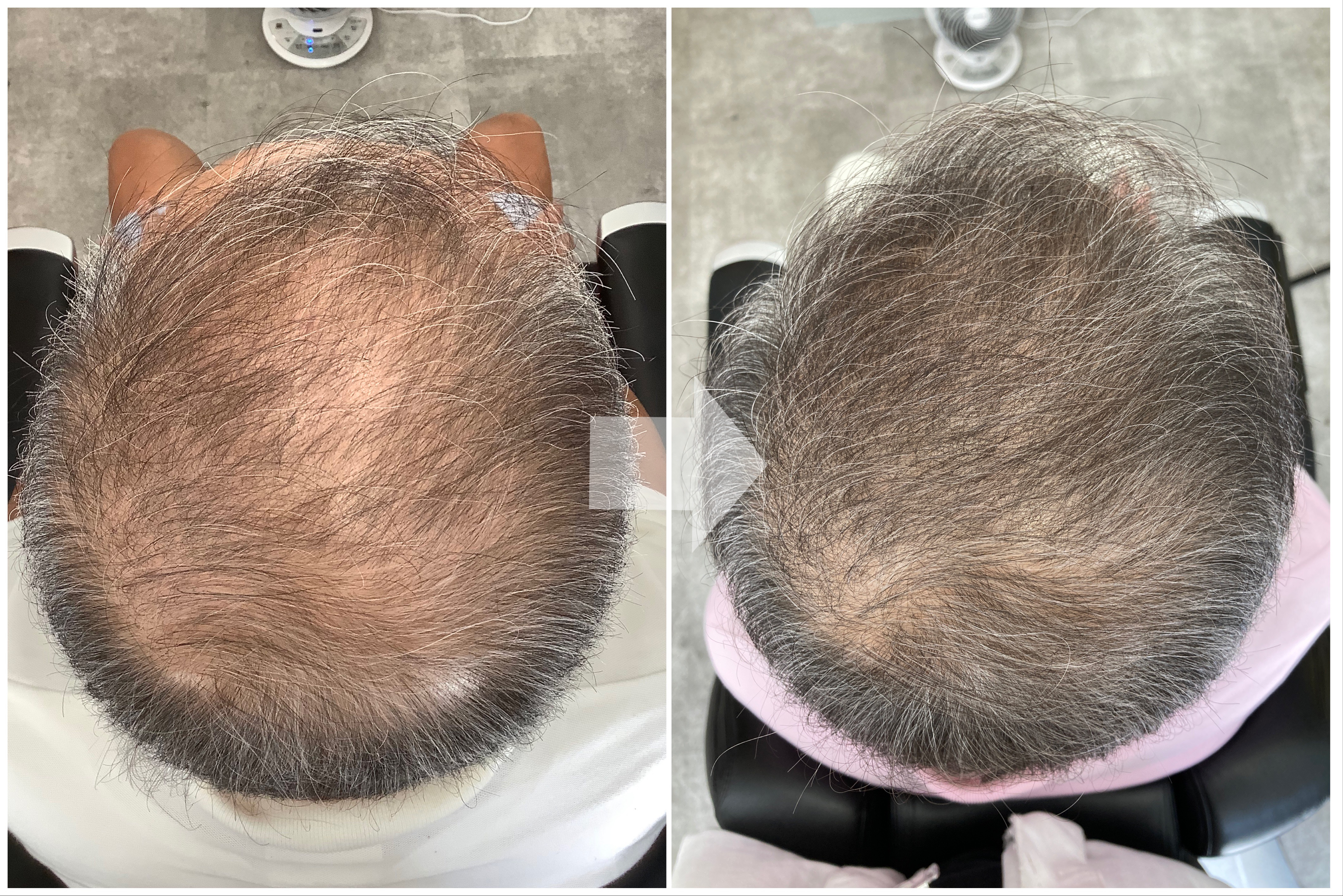 40代男性 薄毛改善 ビフォーアフター